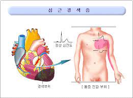 협심증 주요 증상