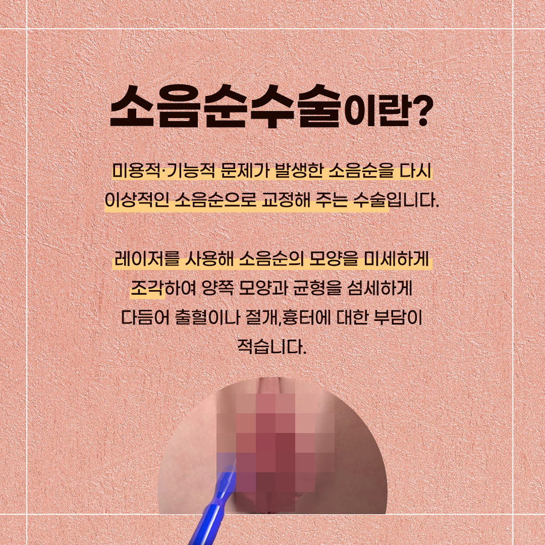 소음수수술후기
소음순수술잘하는곳
소음순수술방법