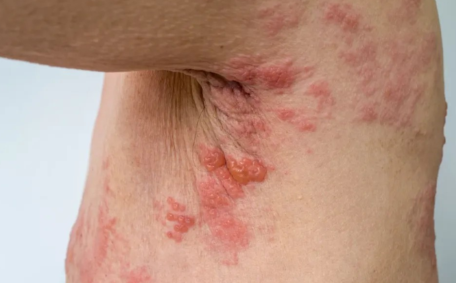 수포 없는 대상 포진의 주요 증상