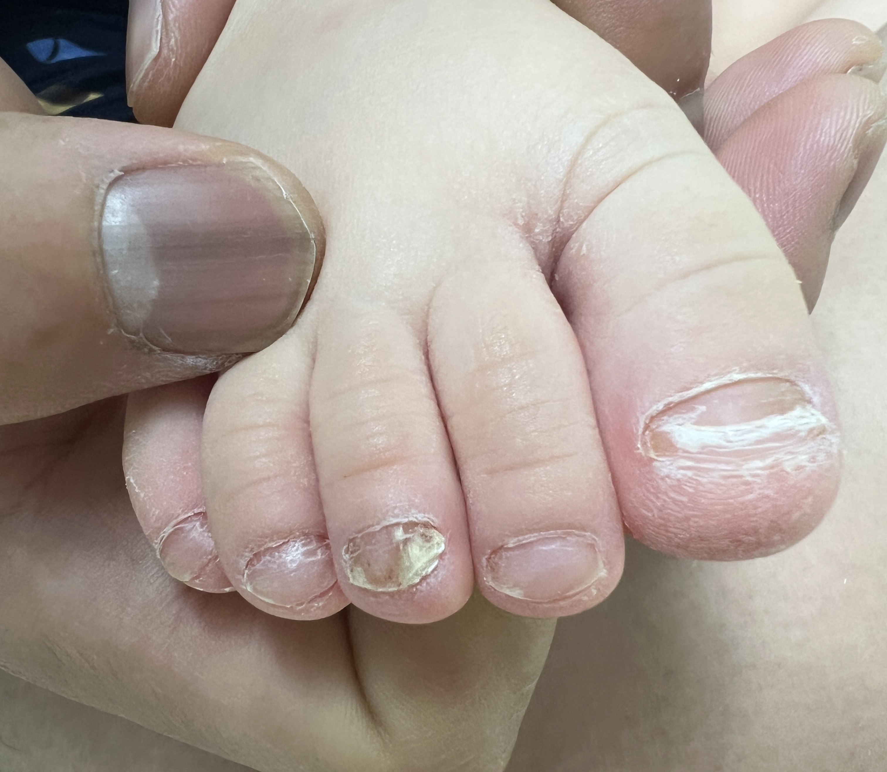 아이 발톱무좀 사진