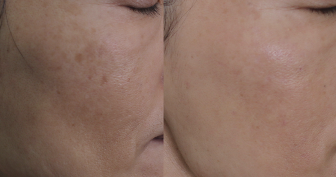 트라넥삼산 선크림을 꾸준히 사용한 후 변화 이미지