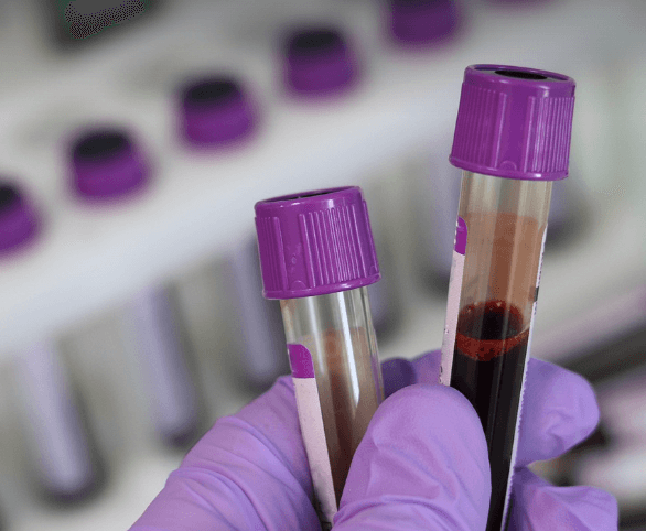 혈액암 초기증상