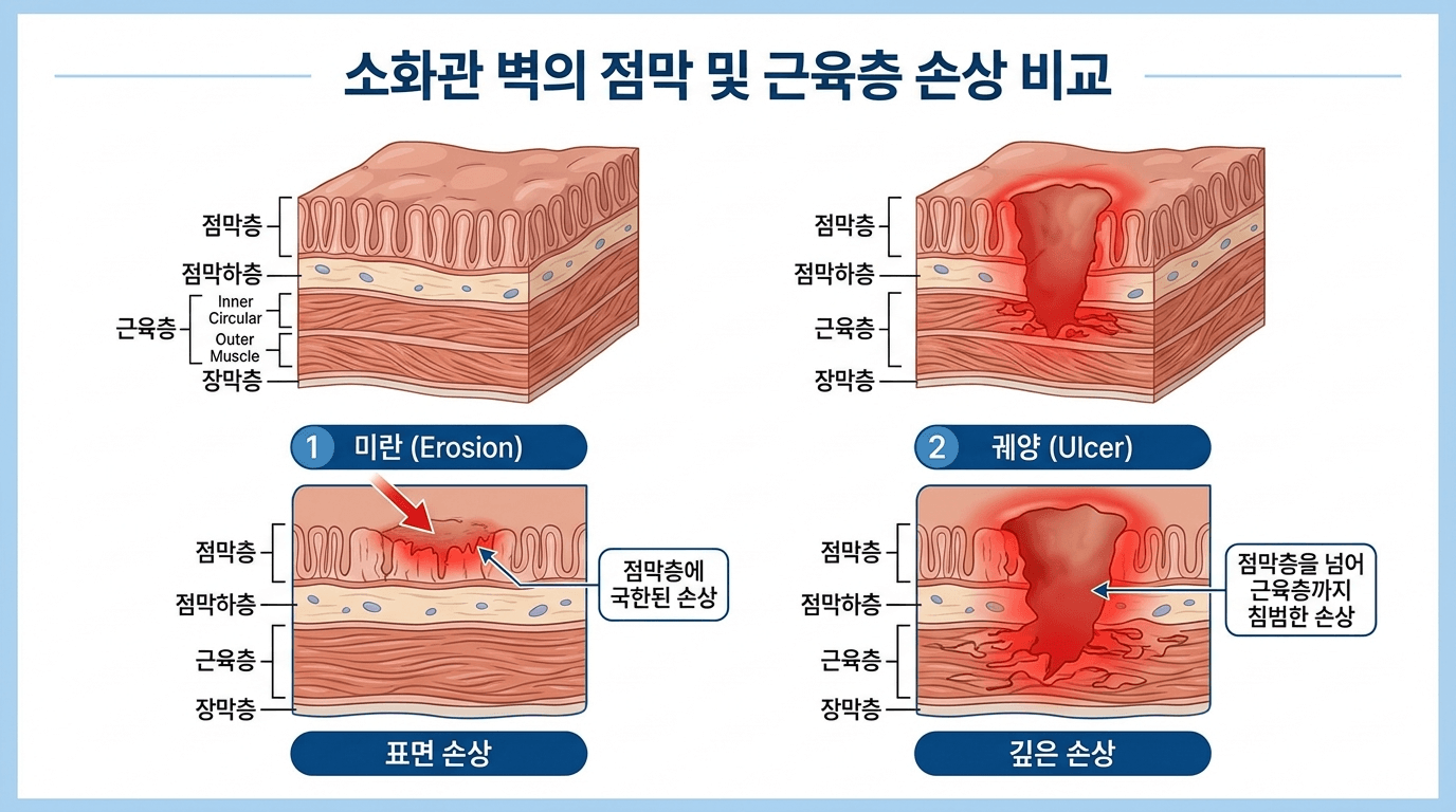 화관 벽의 구조를 보여주며 점막층에 국한된 표면 손상인 '미란'과 근육층까지 깊게 침범한 '궤양'의 차이를 상세히 비교 설명하는 의학 해부학 인포그래픽