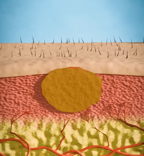 곤지름 초기증상
