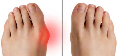 무지외반증 증상, 원인, 치료방법 / 무지외반증깔창, 운동