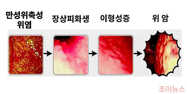 장상피화생이 암으로 진행되는 과정_이미지출처: 유튜브 내과전문의닥터케이