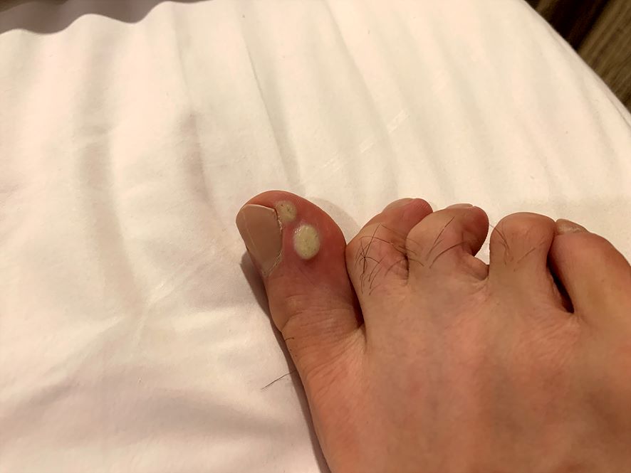 엄지발가락 사이에 생긴 사마귀에 앤드와츠를 바른 3일 뒤 모습
