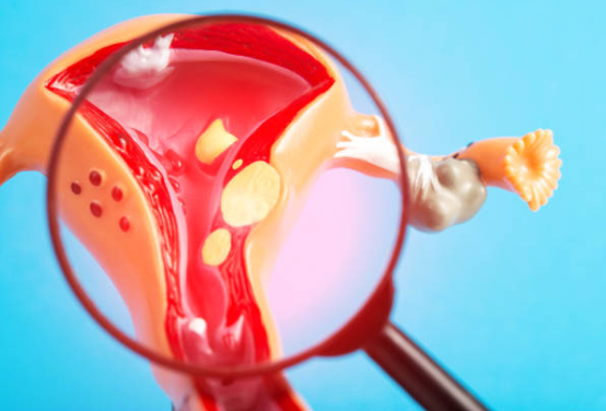 자궁근종의 원인과 증상, 진단, 치료와 예방 방법.