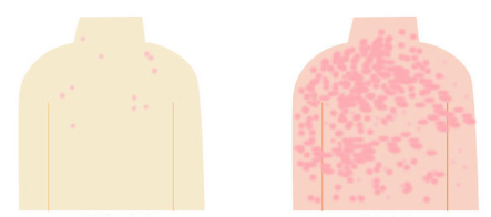 일반 수두와 중증 수두