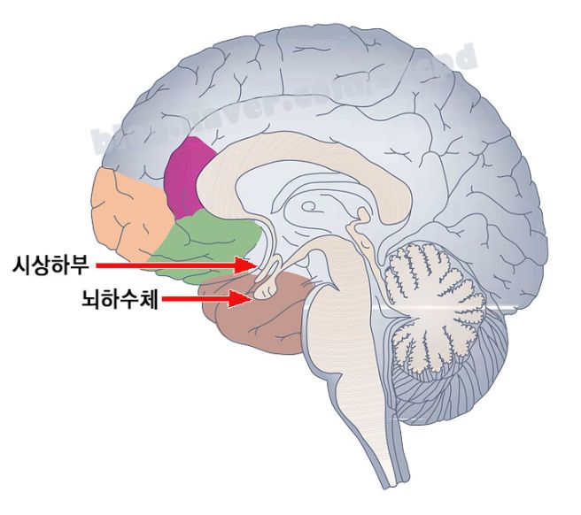 뇌하수체 종양 증상