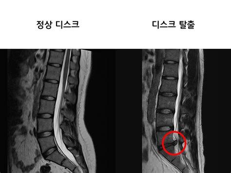 디스크