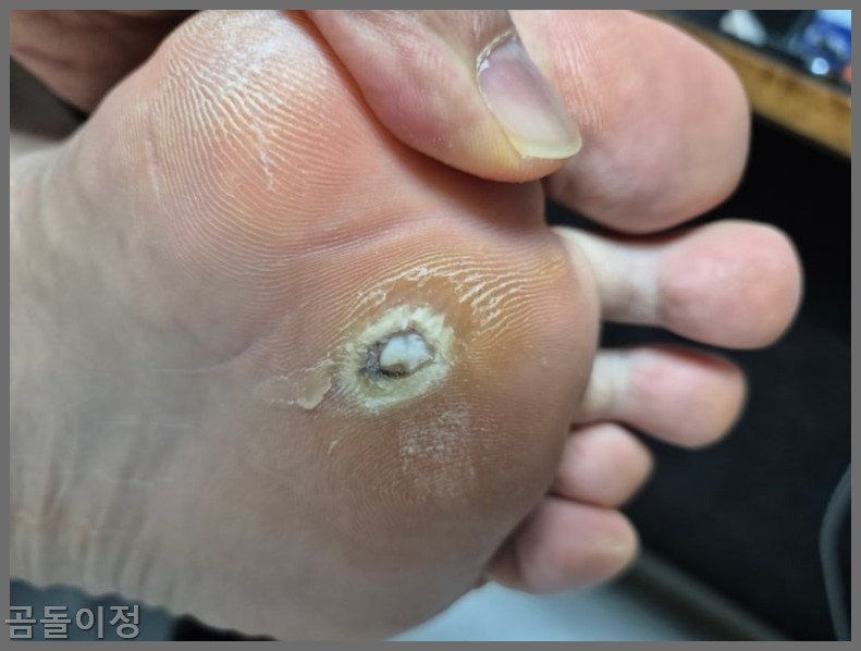 발바닥 티눈 치료법부터 재발 방지까지, 실제 후기로 정리한 팁