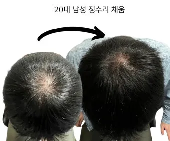 정수리가 아픈 이유와 완화하는 방법_18