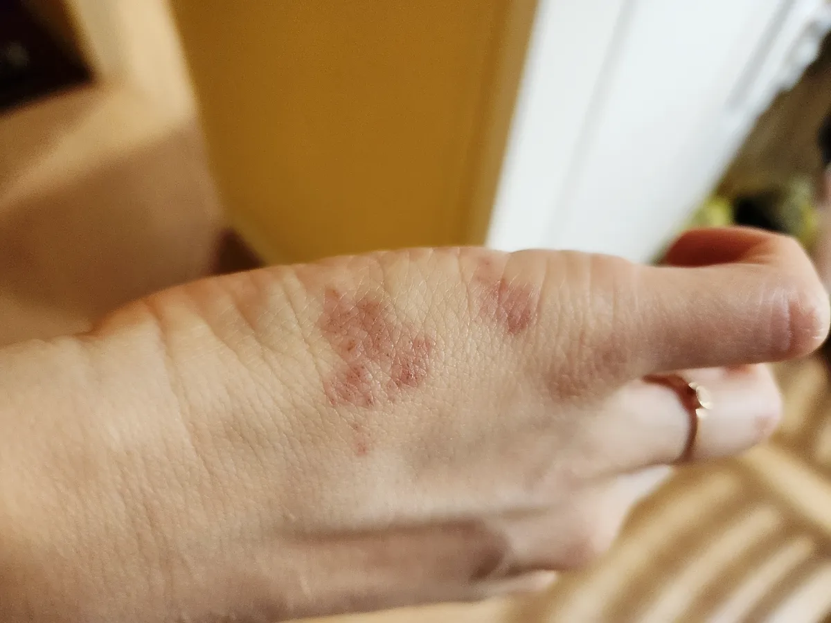 대상포진-손-자국