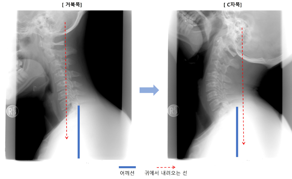 거북목-예방-Tip-이미지