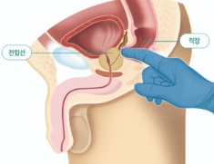 전립선비대증 치료와 좋은음식 총정리