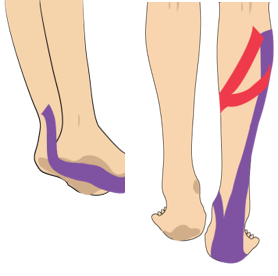 종아리 부종(혈관부종)