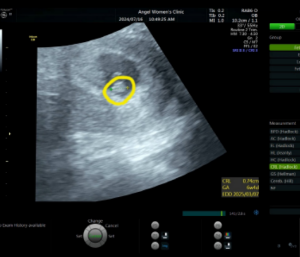 입덧 언제 시작하고 언제 끝날까