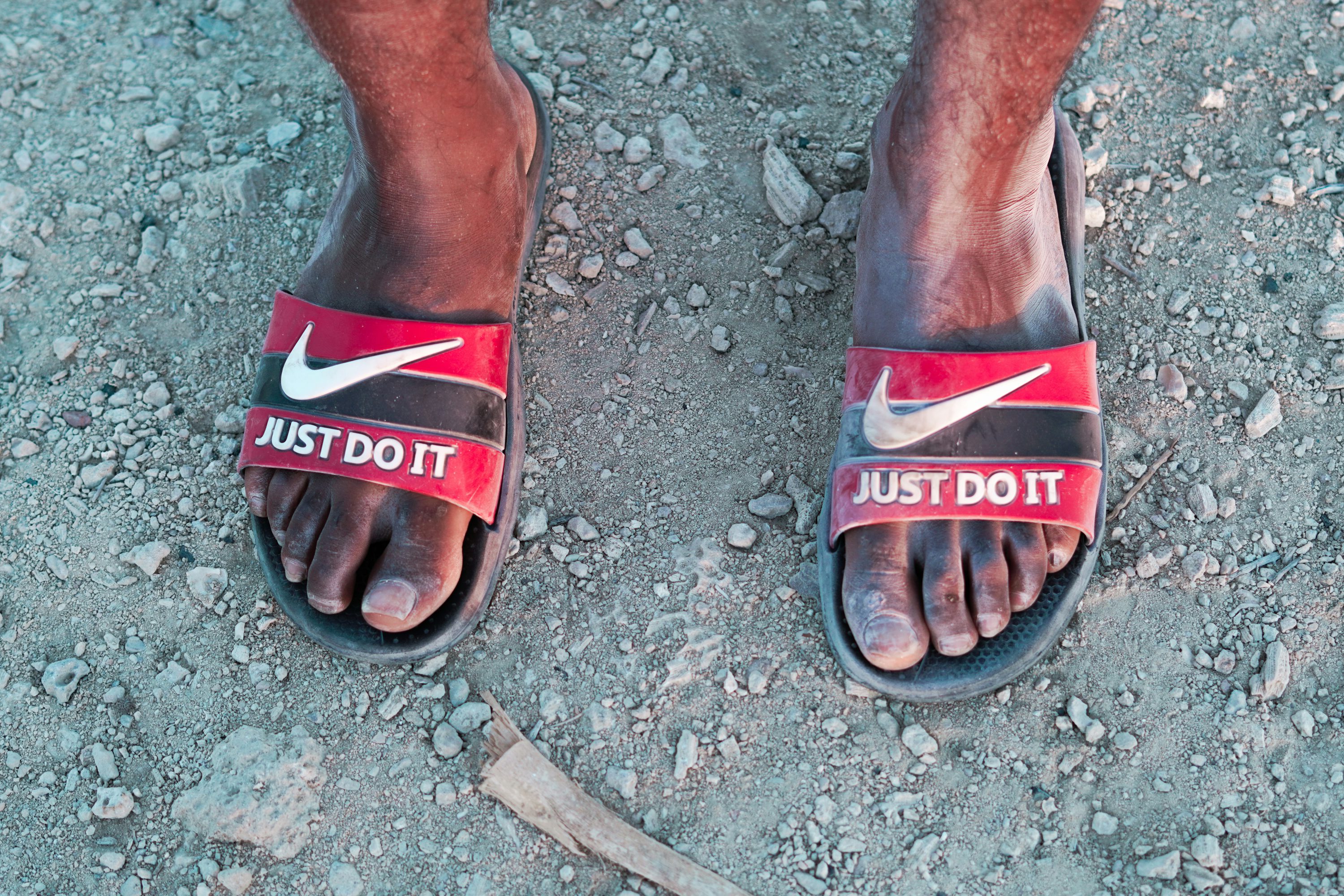 지간 신경종 치료