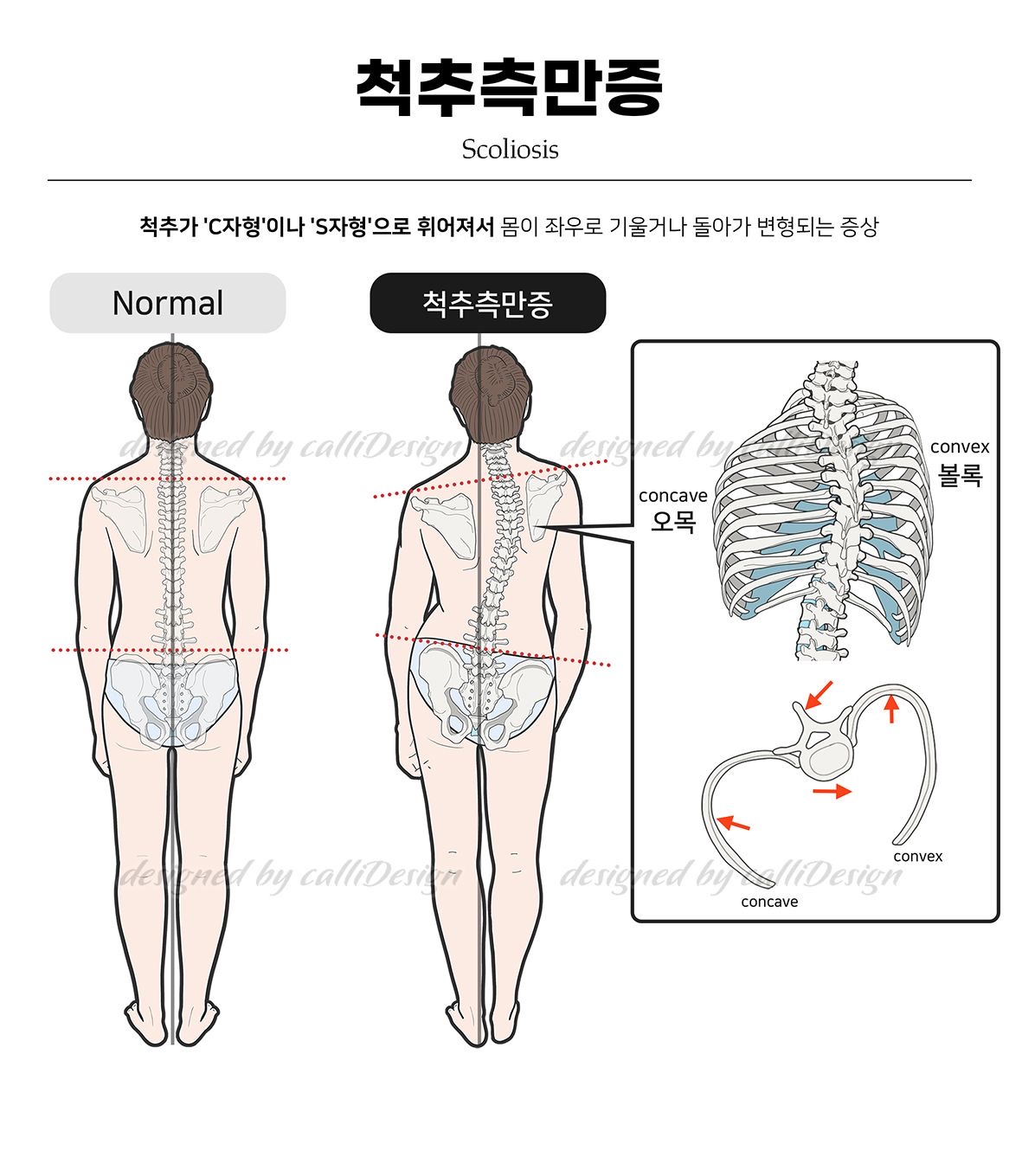 척추측만증 설명