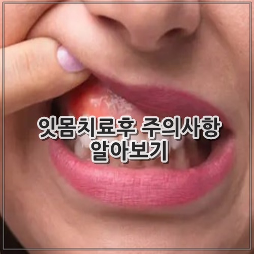 잇몸치료후 주의사항 알아보기