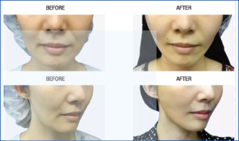 실리프팅 비포애프터