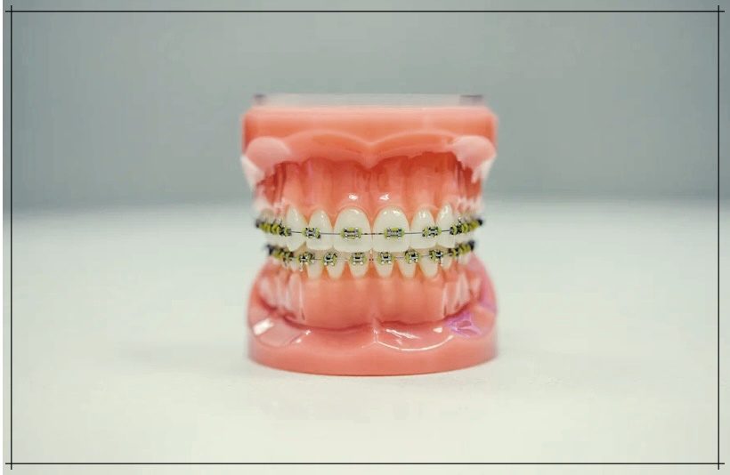 하악골 융기란? 원인. 해결책까지 모든 정보.