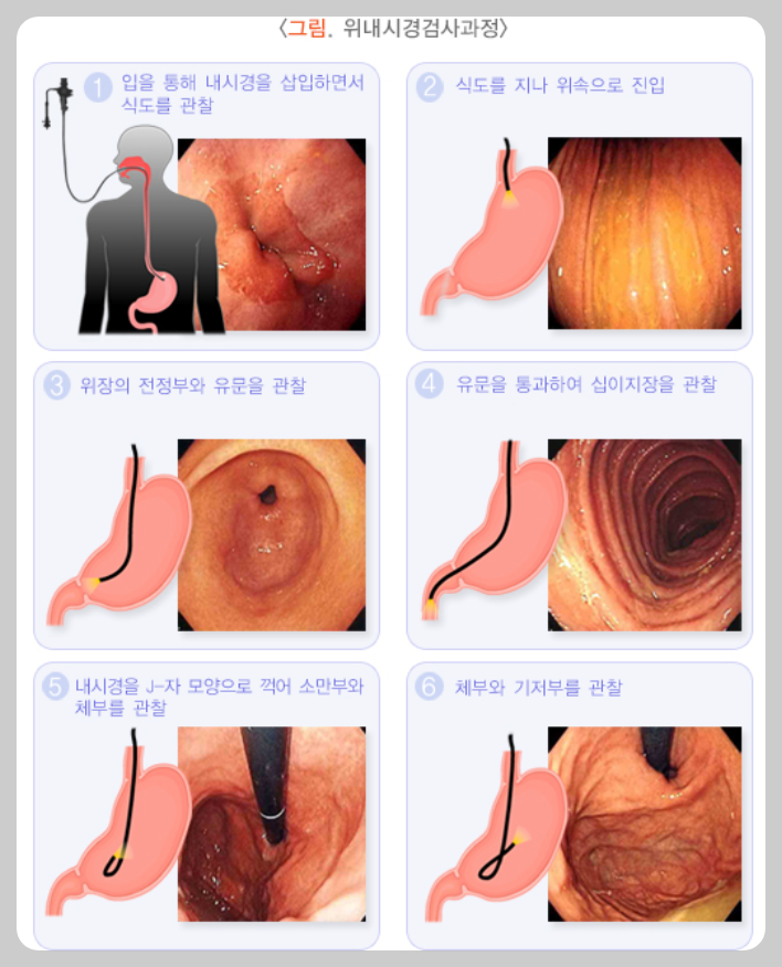 위내시경 검사 과정