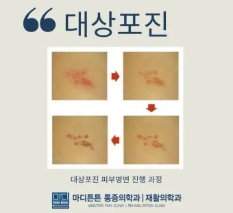 경기도 대상포진 무료접종 연령 기준 정리로 안내_5