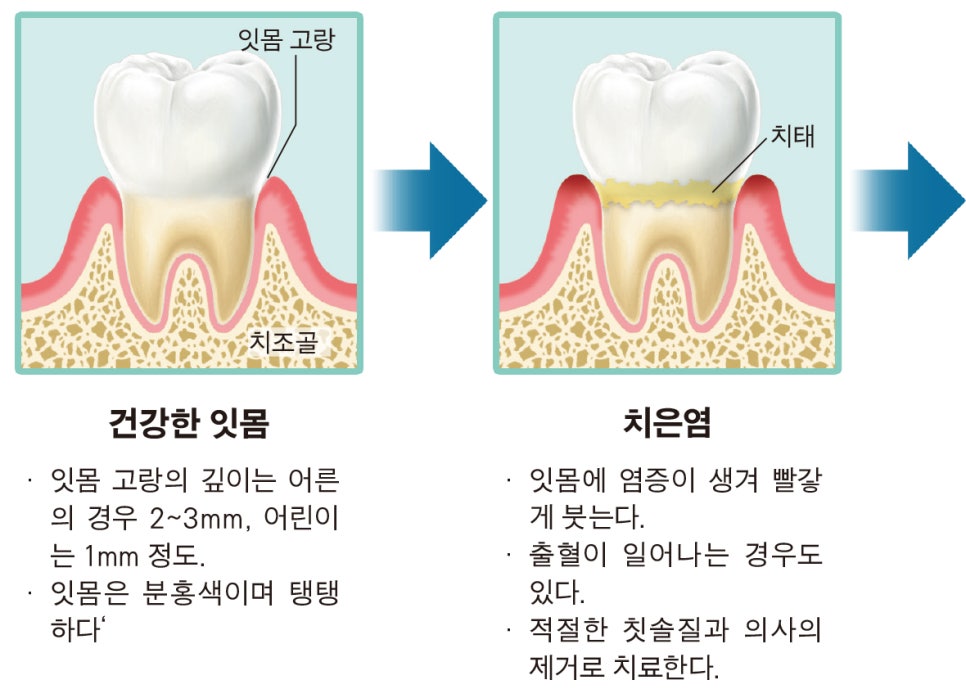치주질환의 부주의시 악화되는 병세-01