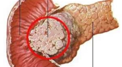 췌장에좋은음식이미지