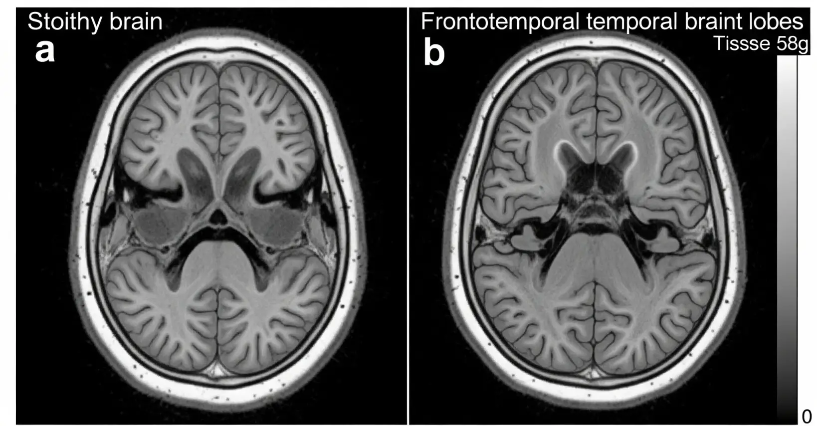 보통사람의 정상적 구조의 뇌