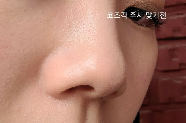 코조각주사 후기