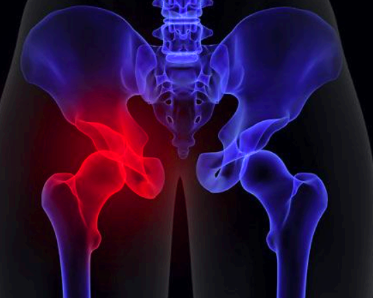 고관절 통증 치료법 