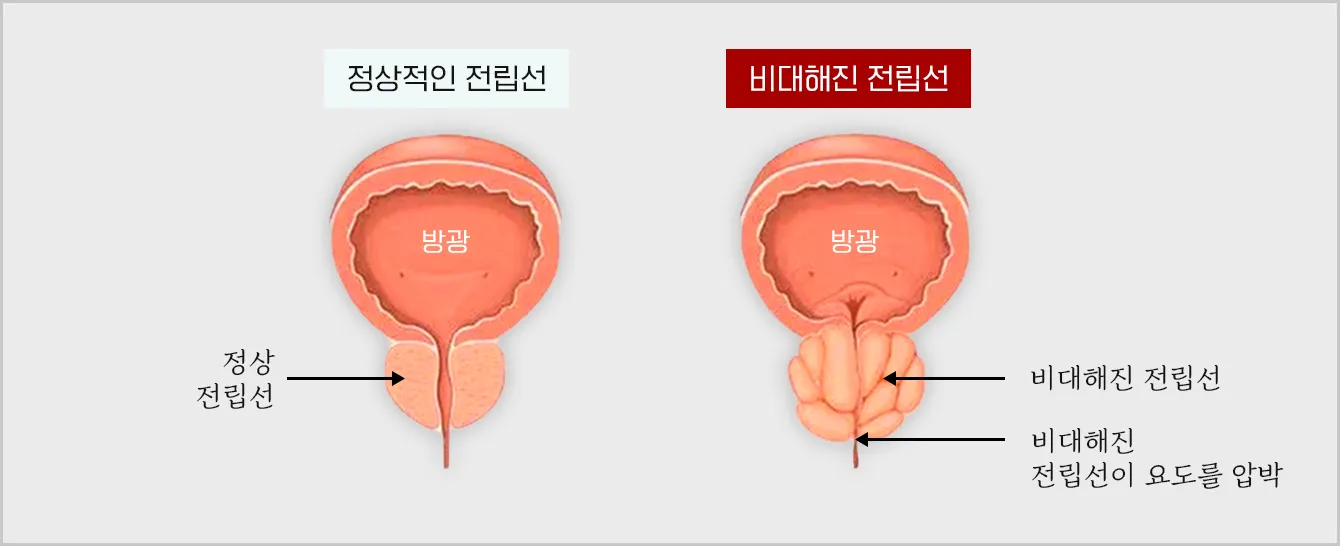 정상적인-전립선과-비대해진-전립선-비교