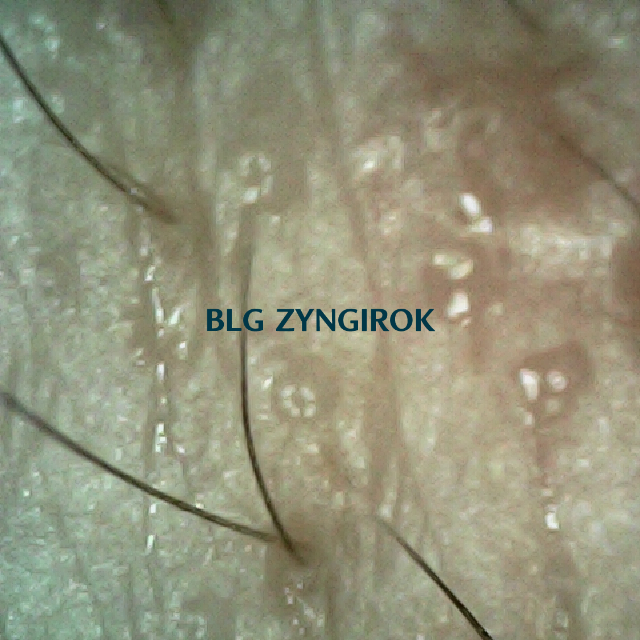 피나모아 복용 6주차 두피사진 - 오른쪽 M자 부위 모습이다.