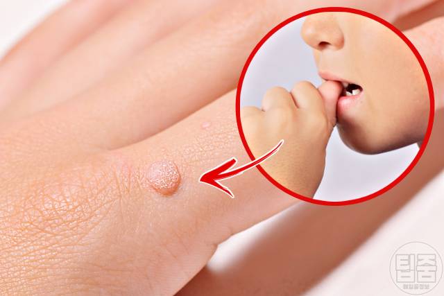 손 사마귀 제거 연고