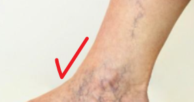 모세혈관 확장증