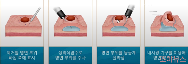조기 위암의 내시경치료 원리