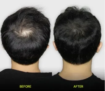 정수리가 아픈 이유와 완화하는 방법_23