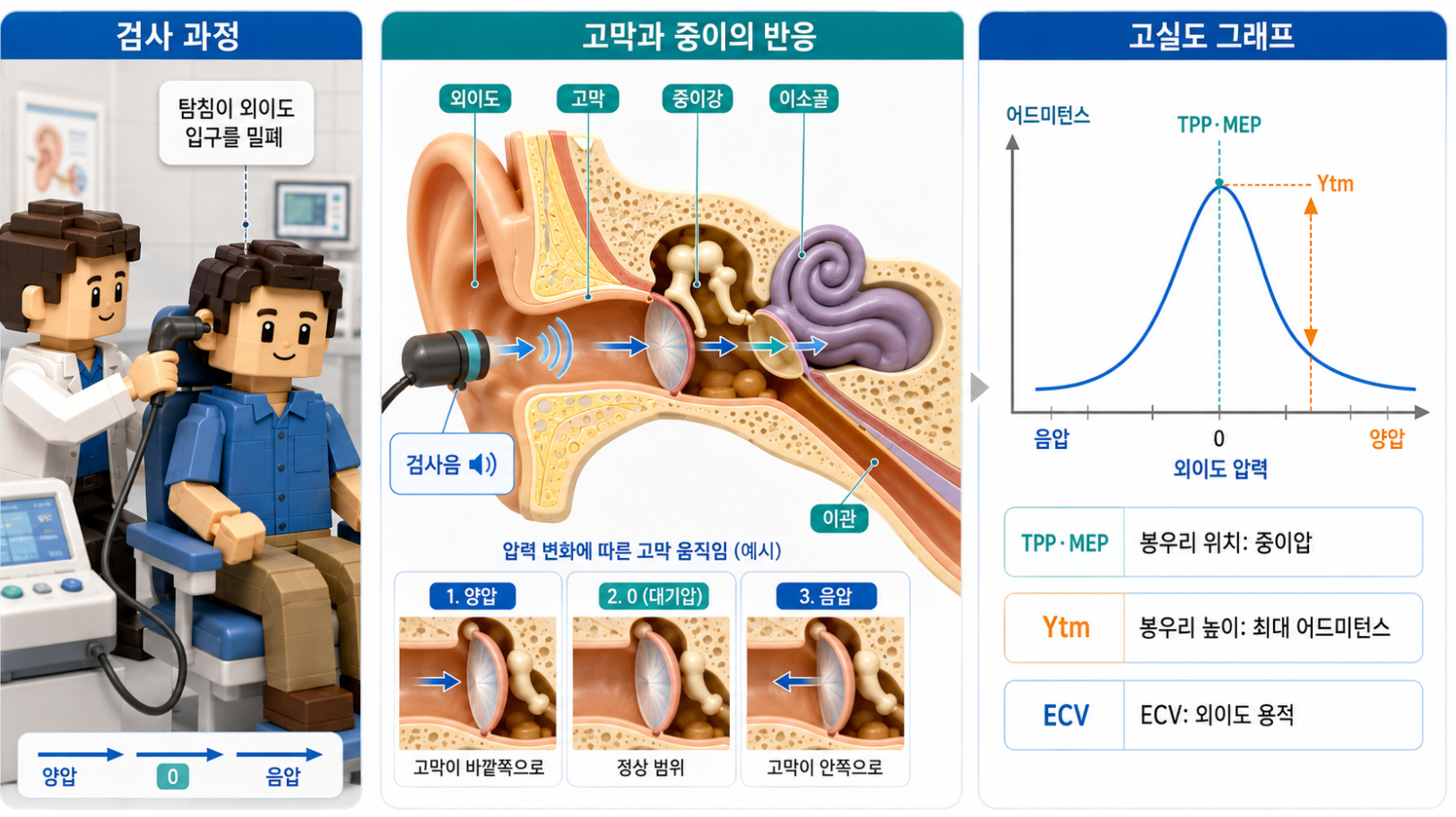 고막운동성검사의 측정 원리와 외이도 압력, 고막·중이 반응, 고실도 그래프를 설명하는 의료 인포그래픽