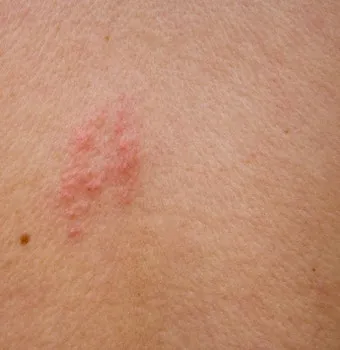 경기도 대상포진 무료접종 연령 기준 정리로 안내_4