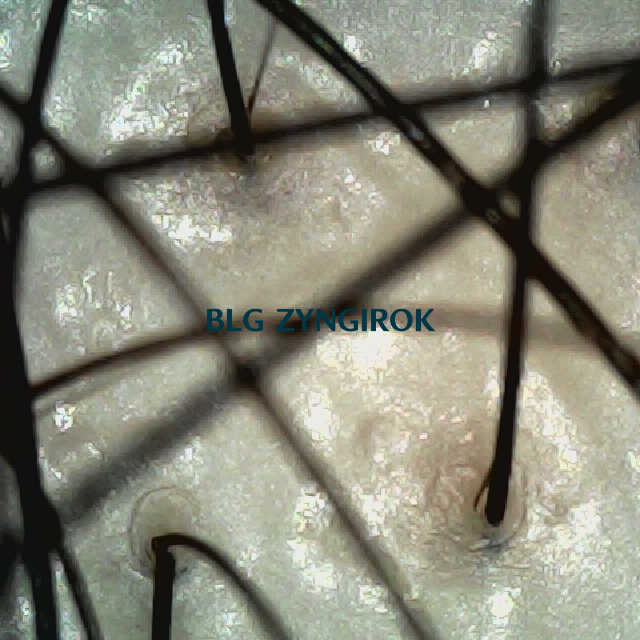 탈모 극복 프로젝트 - 정수리와 이마 사이 두피 모습이다.