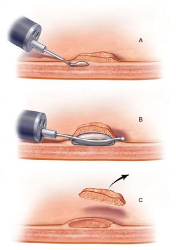 용종과 선종의 차이