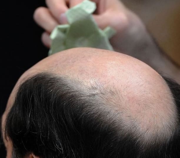 프로페시아 부작용