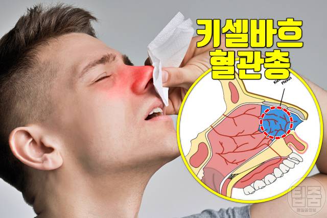 과로증상 피곤하면 코피가 나는 이유 혈뇨 쌍커풀 입술물집 귀가멍멍 코골이 두드러기