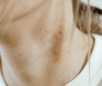 멍이 잘 드는 이유와 오래가는 이유&amp;#44; 병일까?