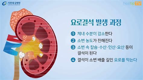 요로 결석 보험