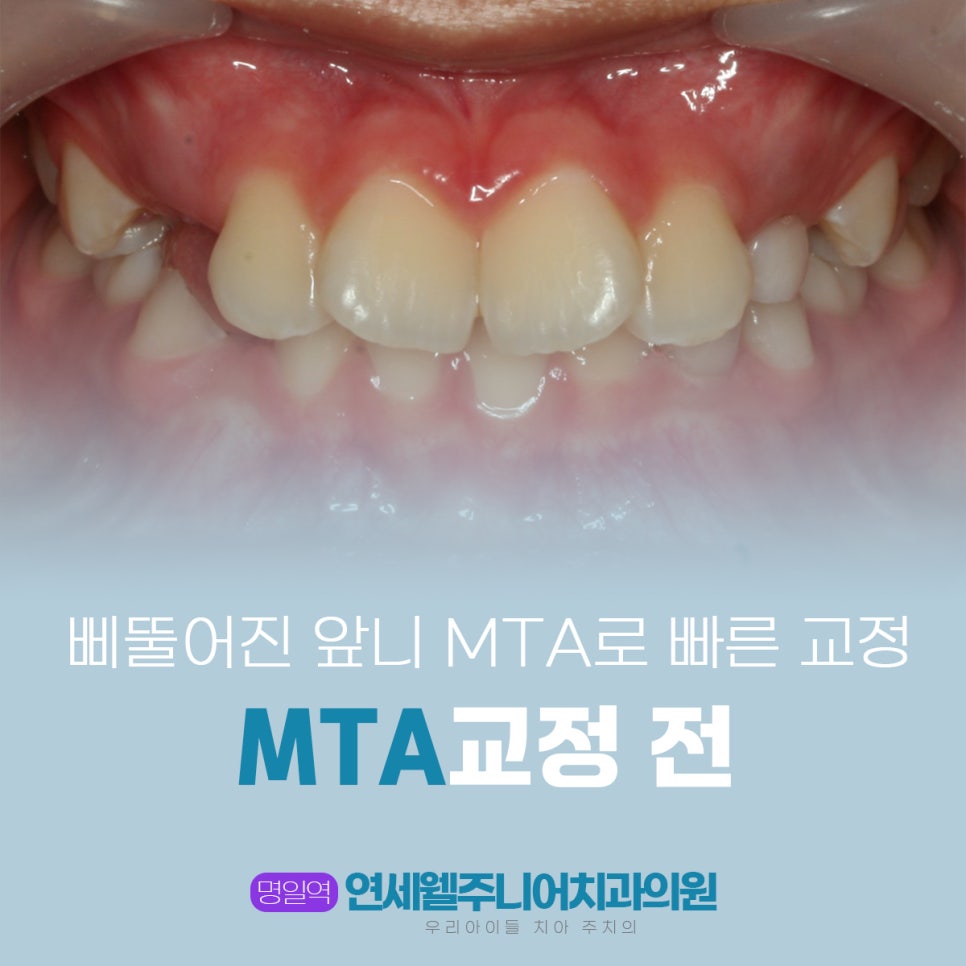 삐뚤어진 앞니를 개선하기 전 어린이 MTA 교정 전 치아 상태