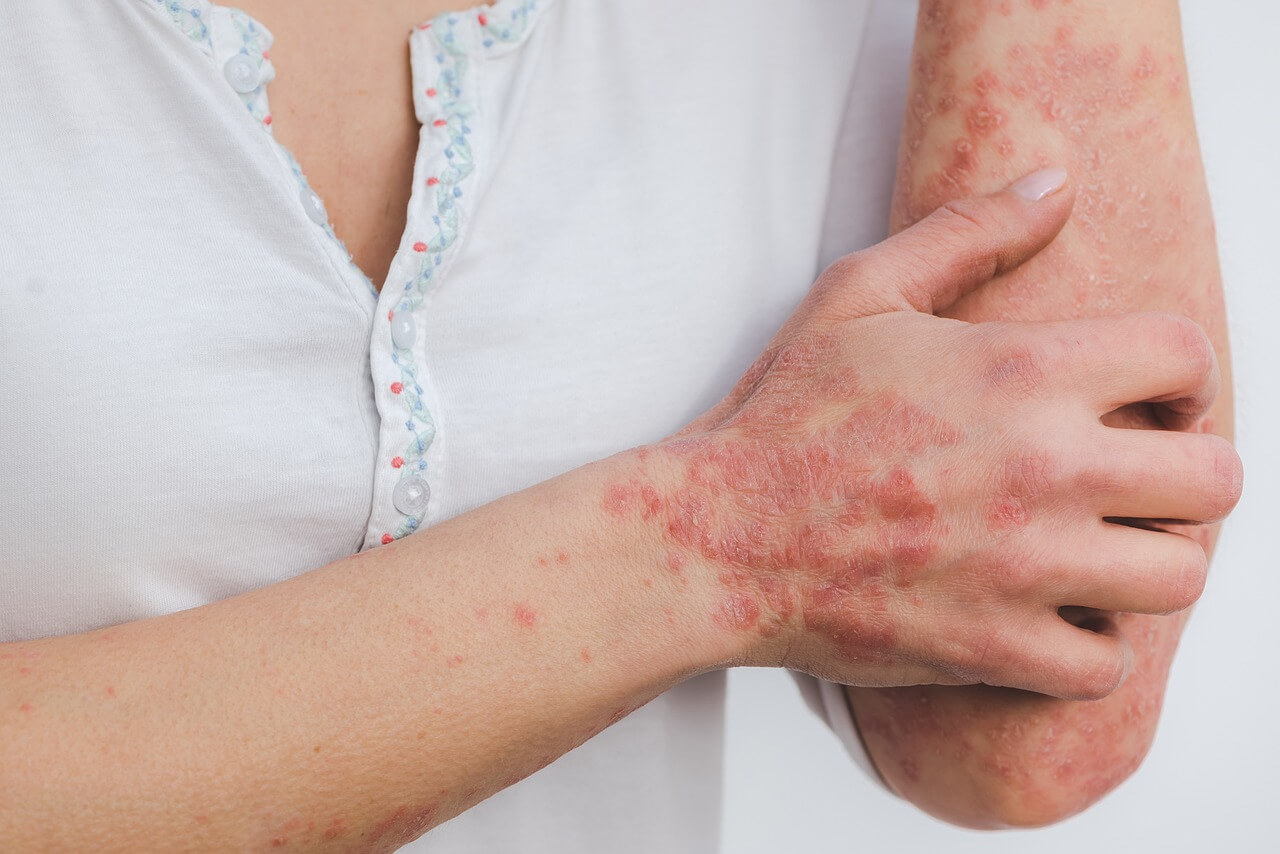 땀띠(Miliaria) 원인 증상 및 치료 방법